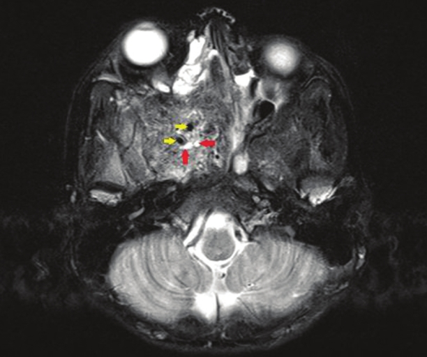 Axial section, T2-weighted magnetic resonance image reveals a large, well-defined mass in the region of the pterygo-maxillary fissure and spheno-palatine foramen on the right side with heterogenous intensity. Avid enhancement of the mass (red arrows) and tiny flow voids are noted within the lesion (yellow arrows) consistent with hypervascularity.